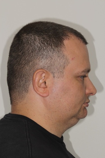 dr-gustavo-boehmer-antes-depois-case-2