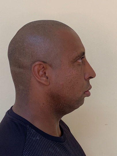 dr-gustavo-boehmer-antes-depois-case-3
