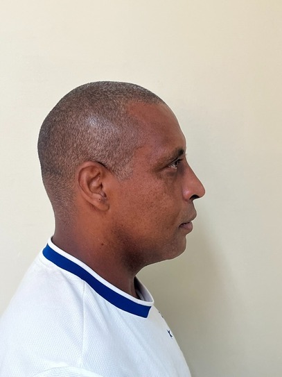 dr-gustavo-boehmer-antes-depois-case-4