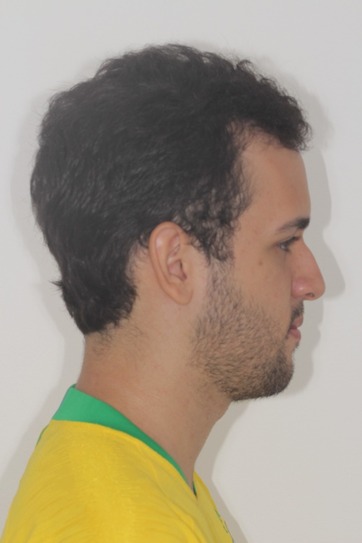 dr-gustavo-boehmer-antes-depois-case-5