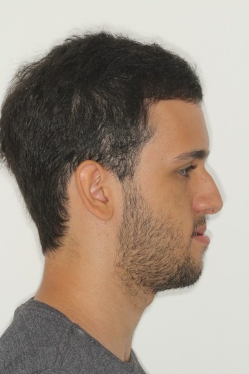 dr-gustavo-boehmer-antes-depois-case-6