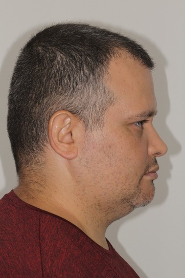 dr-gustavo-boehmer-antes-depois-case